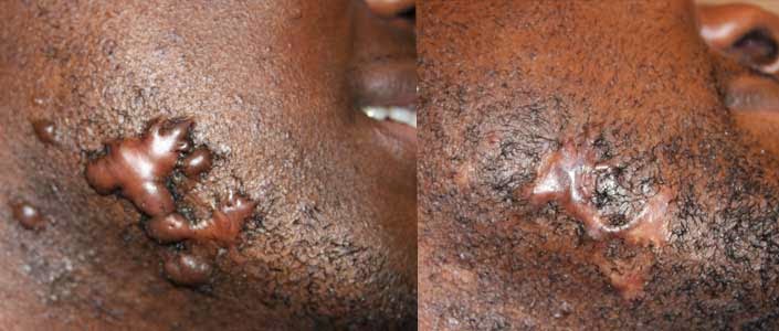 Photo of Keloid Treatment Center in New York City, New York, United States - 7 Picture of Point of interest, Establishment, Health