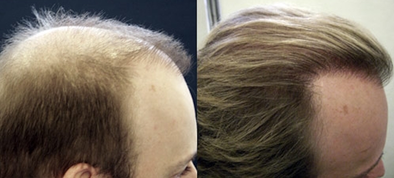Photo of USNY Trichology Institute Hair Loss Specialty Group in New York City, New York, United States - 3 Picture of Point of interest, Establishment, Health, Hair care