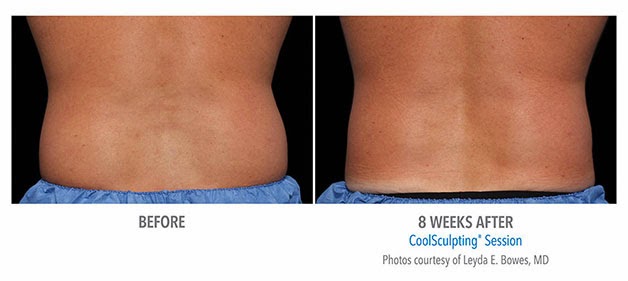 Photo of CoolSculpting Spa of Long Island in Great Neck City, New York, United States - 4 Picture of Point of interest, Establishment, Health, Hospital, Doctor