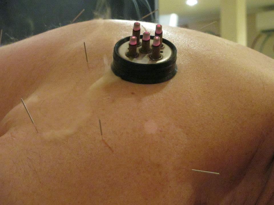 Photo of Zen-Ohs Acupuncture in New Hyde Park City, New York, United States - 4 Picture of Point of interest, Establishment, Health