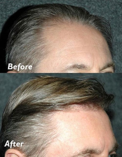 Photo of New York Hair Transplantation in Great Neck City, New York, United States - 6 Picture of Point of interest, Establishment, Health, Hospital, Doctor, Hair care