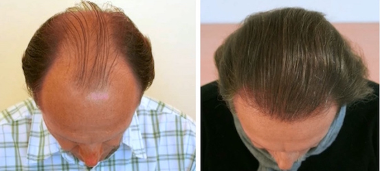 Photo of USNY Trichology Institute Hair Loss Specialty Group in New York City, New York, United States - 4 Picture of Point of interest, Establishment, Health, Hair care