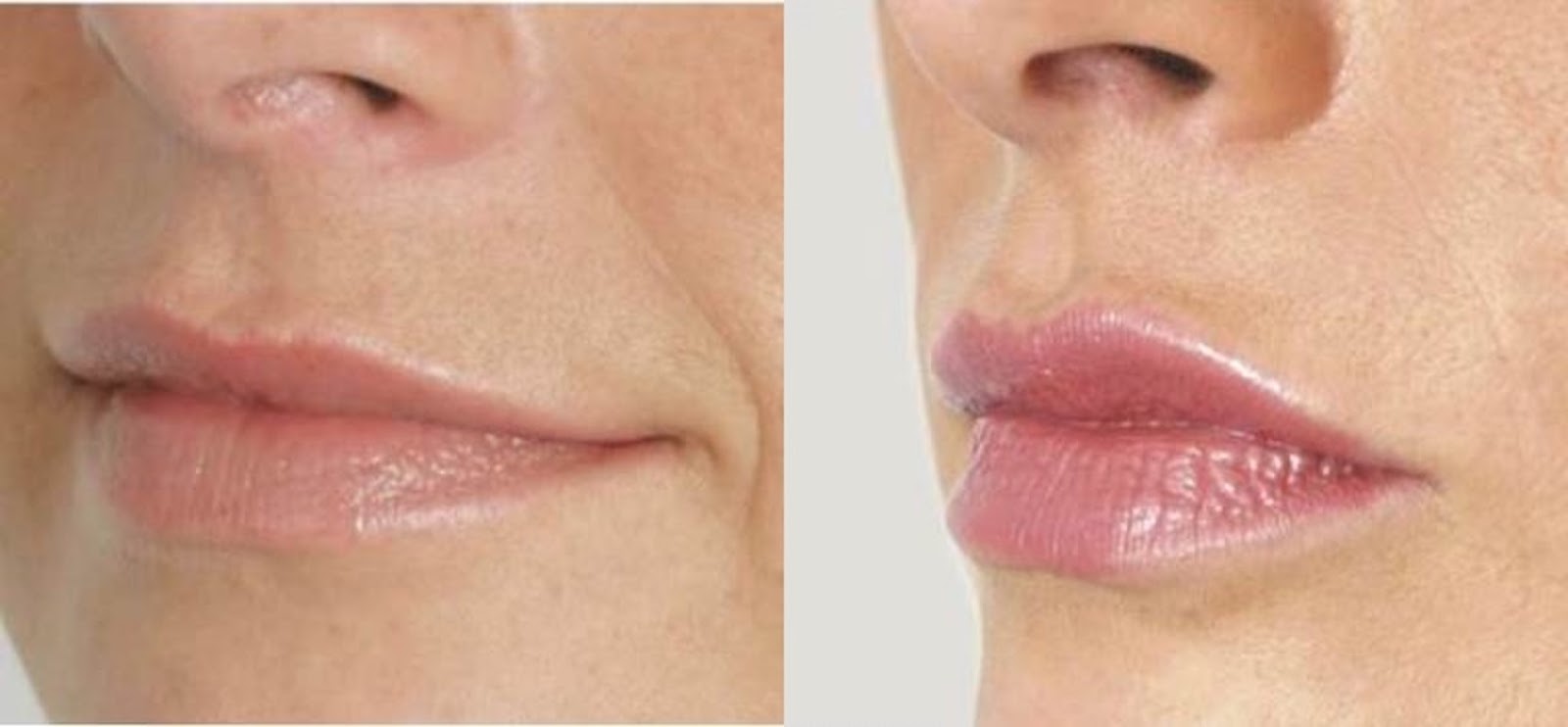 Photo of Lip Injections NYC in New York City, New York, United States - 4 Picture of Point of interest, Establishment, Health, Doctor
