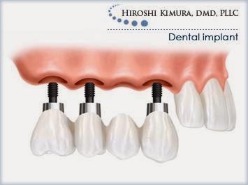 Photo of Periodontic & Dental Implants: Kimura Hiroshi DDS in New York City, New York, United States - 8 Picture of Point of interest, Establishment, Health, Dentist