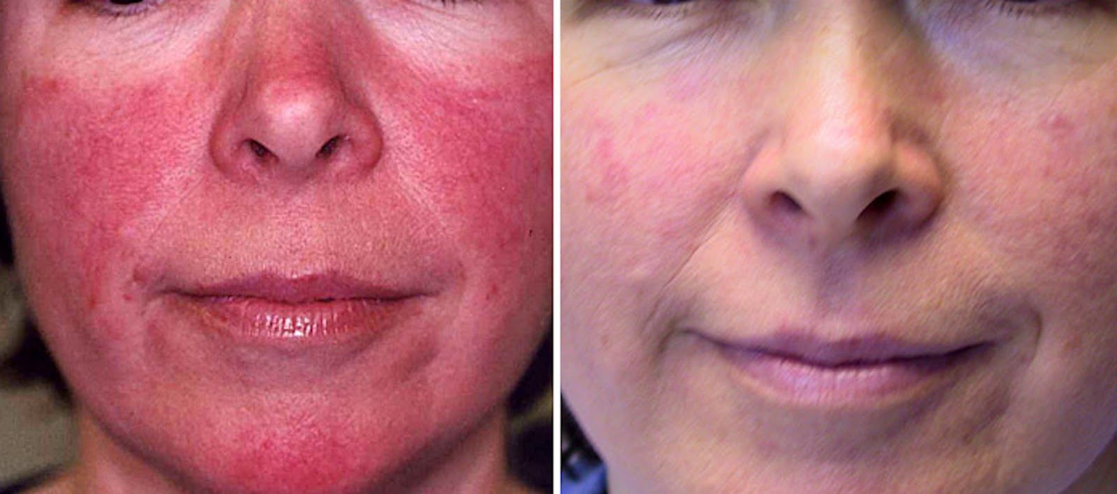 Photo of Rosacea NYC in New York City, New York, United States - 3 Picture of Point of interest, Establishment, Health, Doctor