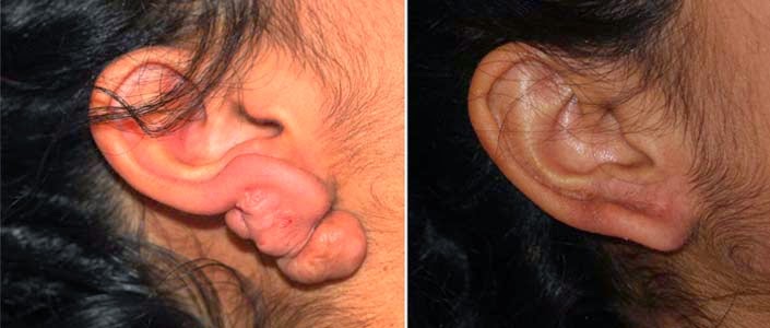 Photo of Keloid Treatment Center in New York City, New York, United States - 6 Picture of Point of interest, Establishment, Health
