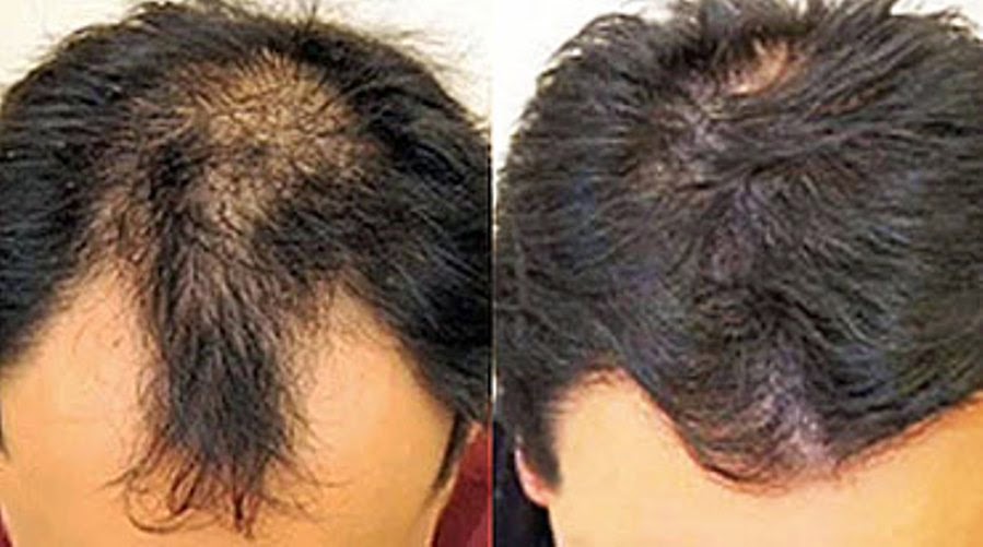 Photo of New York Hair Transplantation in New York City, New York, United States - 5 Picture of Point of interest, Establishment, Health, Doctor, Hair care