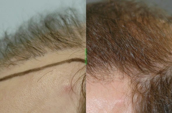 Photo of Dr. Robin H. Unger, MD in New York City, New York, United States - 4 Picture of Point of interest, Establishment, Health, Hair care