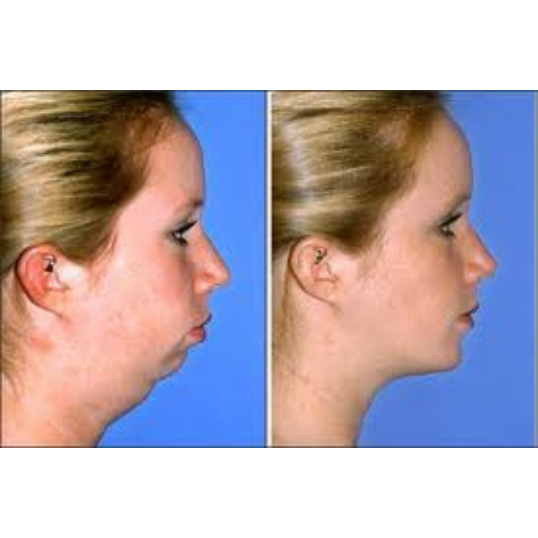 Photo of Chin Implants NYC in New York City, New York, United States - 3 Picture of Point of interest, Establishment, Health, Doctor