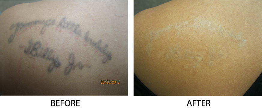 Photo of Tattoo Removal Long Island - Vaginal Rejuvenation Long Island - Evan Shapiro MD in New Hyde Park City, New York, United States - 2 Picture of Point of interest, Establishment, Health, Doctor, Beauty salon, Hair care