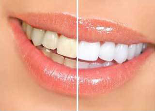 Photo of The Whitening Gals in Bronx City, New York, United States - 1 Picture of Point of interest, Establishment, Health, Dentist