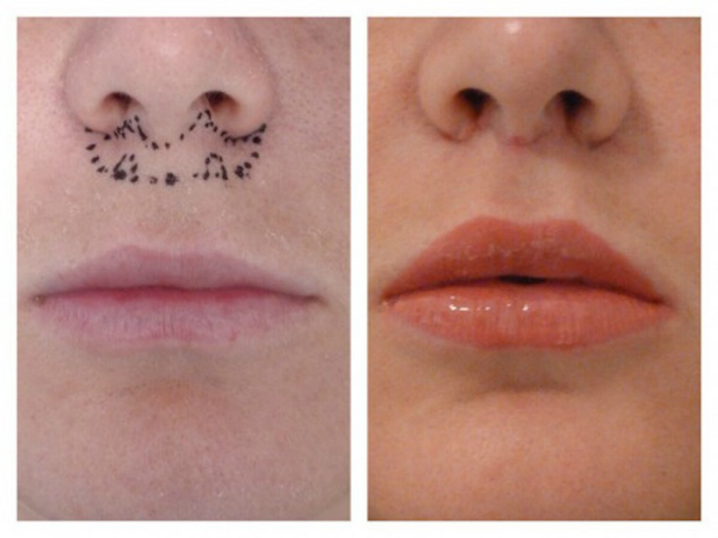 Photo of Lip Lift NYC in New York City, New York, United States - 1 Picture of Point of interest, Establishment, Beauty salon