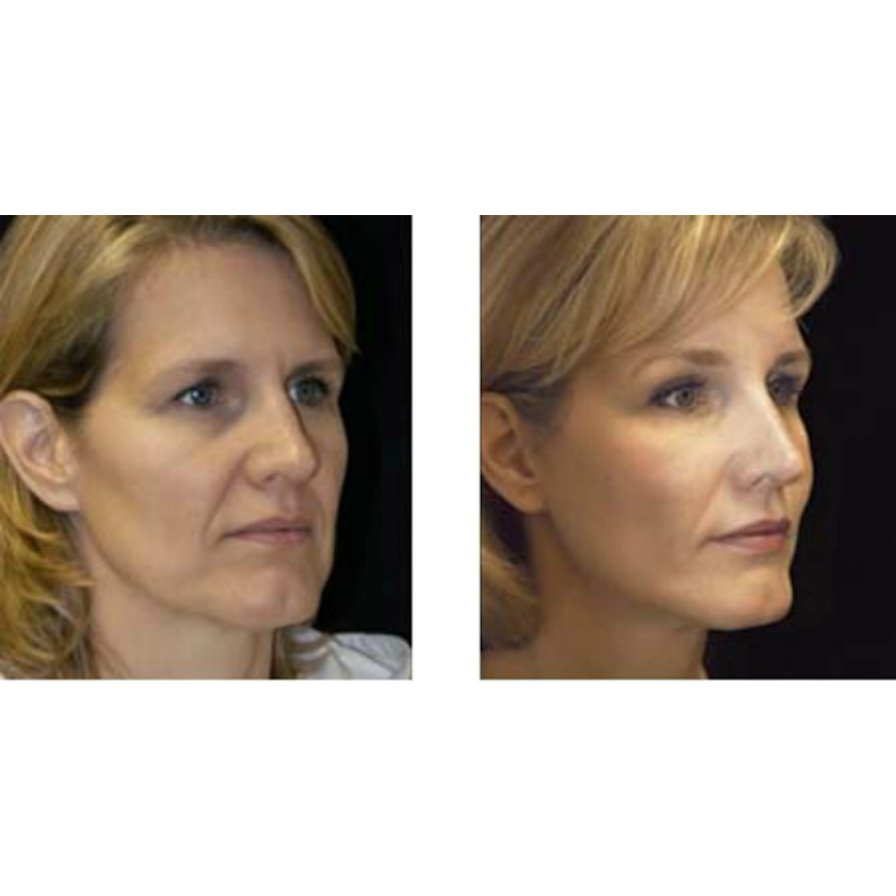 Photo of Liquid Facelift NYC in New York City, New York, United States - 4 Picture of Point of interest, Establishment, Health, Doctor