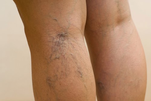 Photo of Varicose Veins Treatment Center NYC in New York City, New York, United States - 3 Picture of Point of interest, Establishment, Health, Doctor, Spa