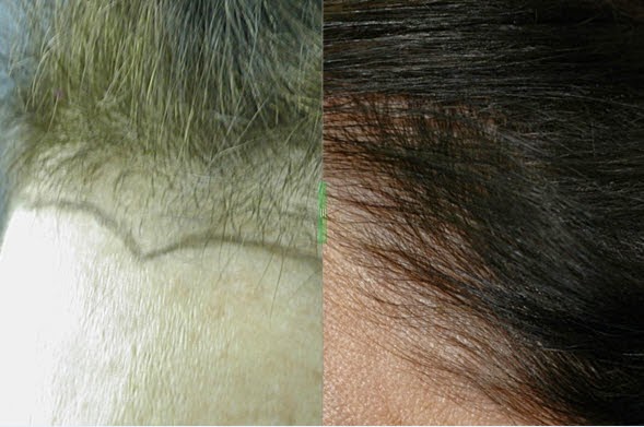 Photo of Dr. Robin H. Unger, MD in New York City, New York, United States - 2 Picture of Point of interest, Establishment, Health, Hair care