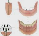 Photo of Sanford N. Gerber, DDS Mini Dental Implants in Elmont City, New York, United States - 5 Picture of Point of interest, Establishment, Health, Dentist