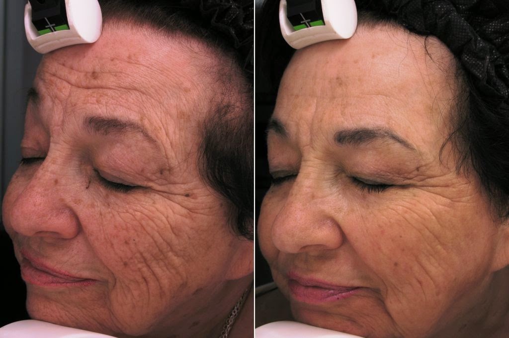 Photo of Cosmetic Laser MD in Livingston City, New Jersey, United States - 8 Picture of Point of interest, Establishment, Health, Doctor, Spa, Beauty salon, Hair care