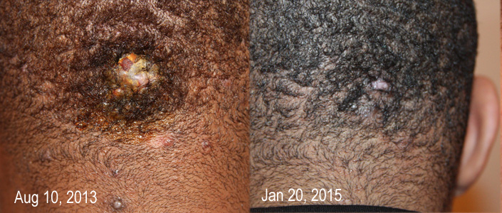 Photo of Keloid Treatment Center in New York City, New York, United States - 8 Picture of Point of interest, Establishment, Health, Doctor