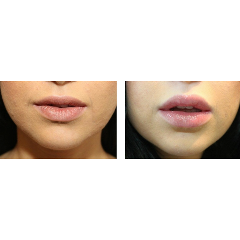 Photo of Lip Injections NYC in New York City, New York, United States - 3 Picture of Point of interest, Establishment, Health, Doctor
