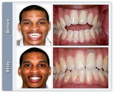 Photo of Straight Teeth in Six Months in New York City, New York, United States - 2 Picture of Point of interest, Establishment, Health, Dentist