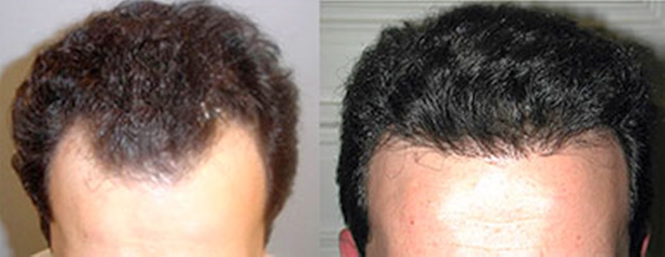 Photo of New York Hair Transplantation in New York City, New York, United States - 10 Picture of Point of interest, Establishment, Health, Doctor, Hair care