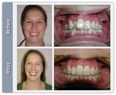 Photo of Straight Teeth in Six Months in New York City, New York, United States - 1 Picture of Point of interest, Establishment, Health, Dentist