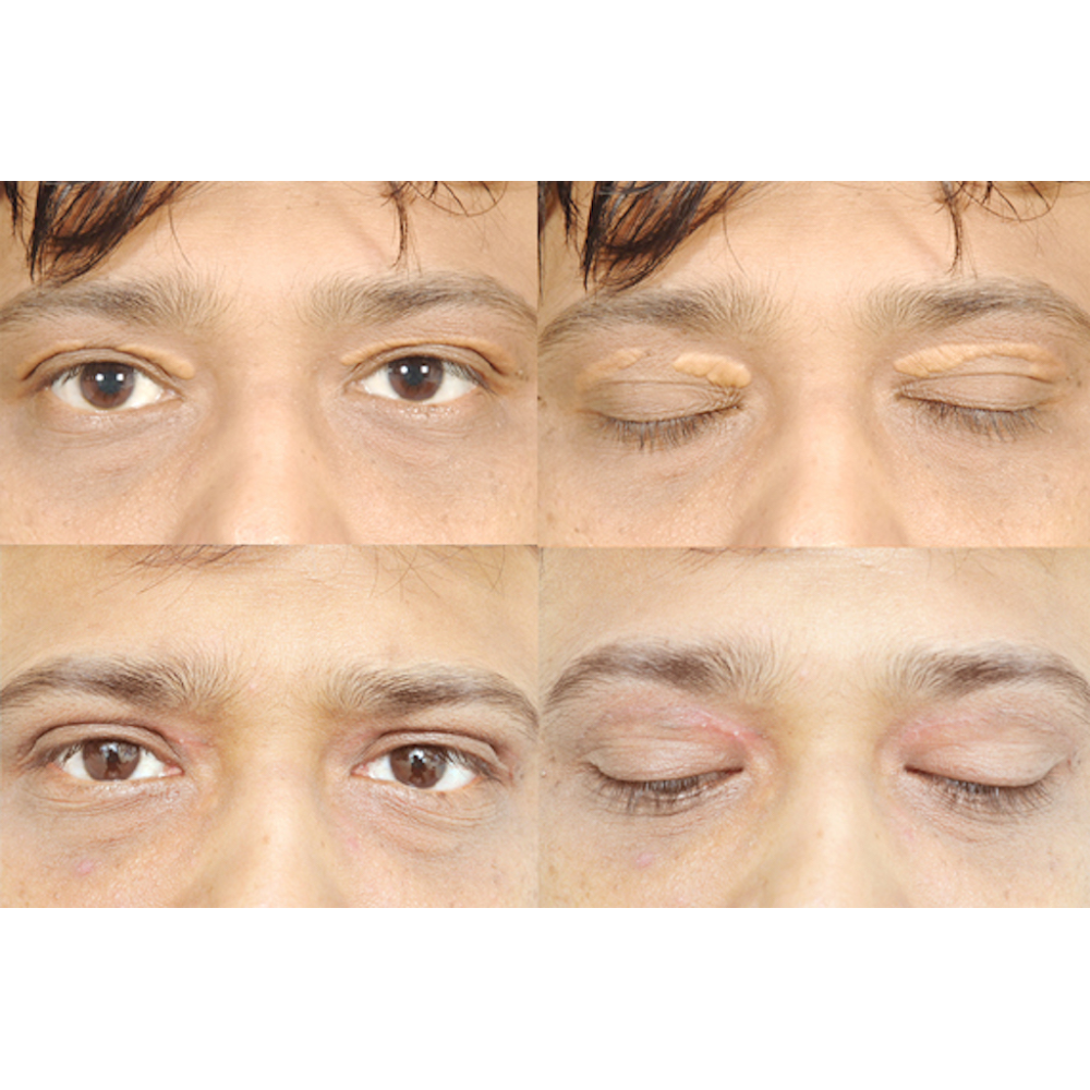 Photo of Xanthelasma NYC in New York City, New York, United States - 3 Picture of Point of interest, Establishment, Health, Doctor