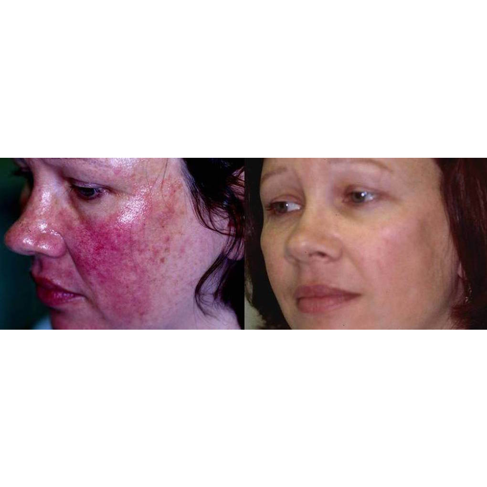 Photo of Rosacea NYC in New York City, New York, United States - 4 Picture of Point of interest, Establishment, Health, Doctor