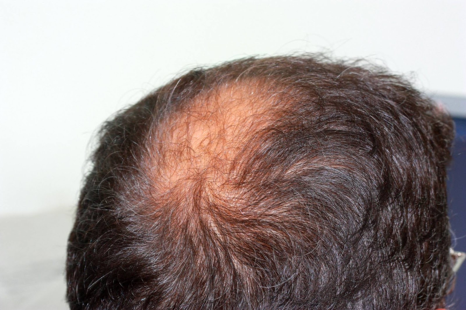 Photo of Park Avenue Hair Transplant in New York City, New York, United States - 3 Picture of Point of interest, Establishment, Health, Hair care