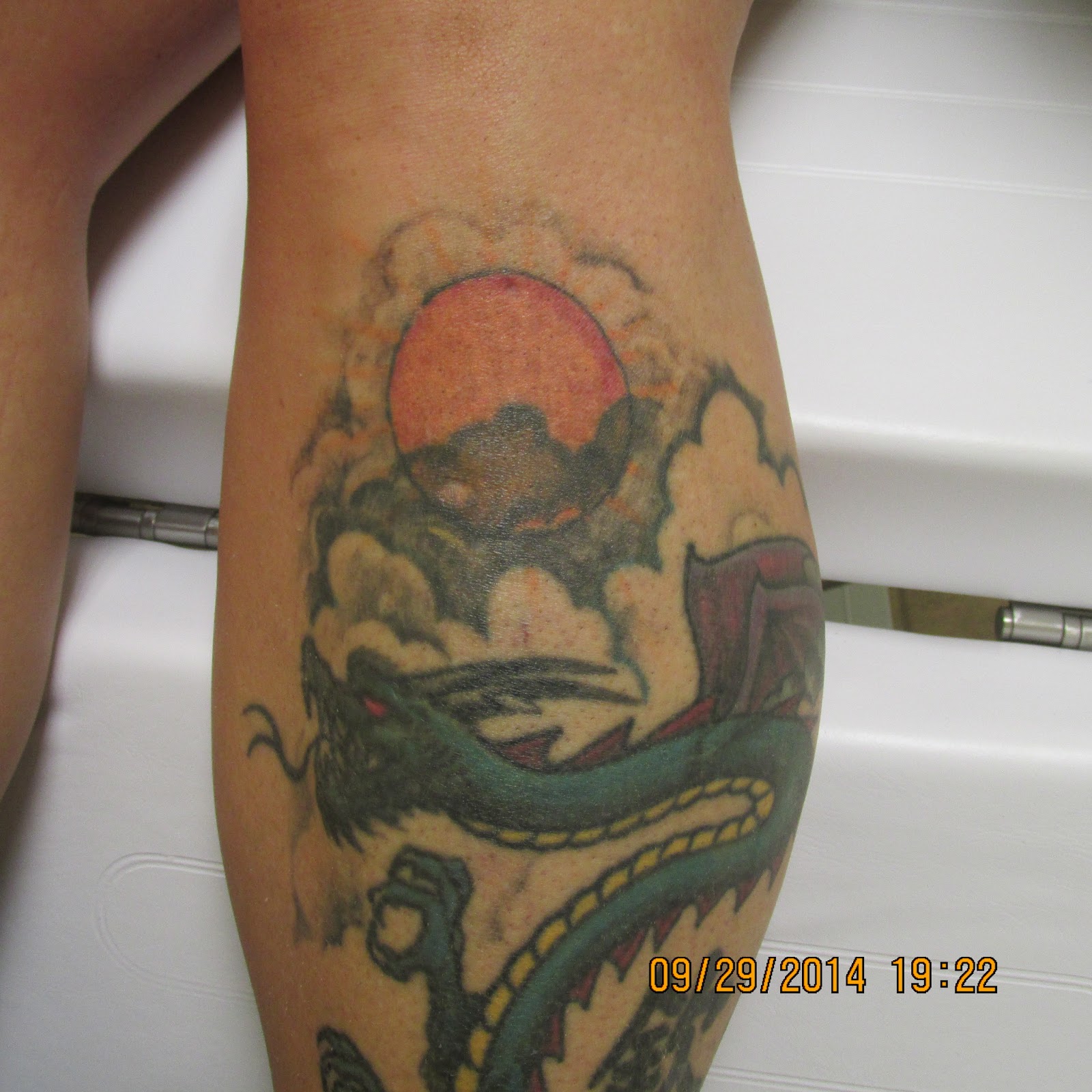 Photo of Brooklyn Laser Tattoo Removal, Inc. in Kings County City, New York, United States - 4 Picture of Point of interest, Establishment, Health