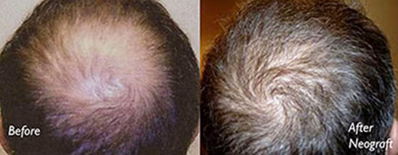 Photo of New York Hair Transplantation in New York City, New York, United States - 3 Picture of Point of interest, Establishment, Health, Doctor, Hair care