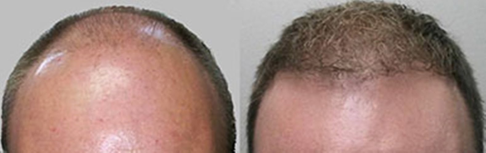 Photo of New York Hair Transplantation in New York City, New York, United States - 6 Picture of Point of interest, Establishment, Health, Doctor, Hair care