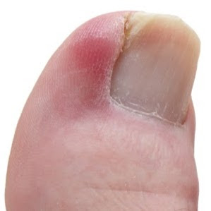Photo of Ingrown Toenail Therapy in Bronx City, New York, United States - 1 Picture of Point of interest, Establishment, Health, Doctor