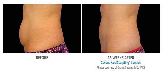 Photo of CoolSculpting Spa of Long Island in Great Neck City, New York, United States - 6 Picture of Point of interest, Establishment, Health, Hospital, Doctor