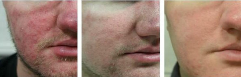 Photo of Rosacea NYC in New York City, New York, United States - 2 Picture of Point of interest, Establishment, Health, Doctor