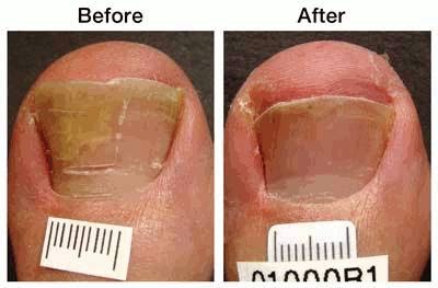 Photo of Toenail fungus laser certified Dr. Martin G. Miller in Freeport City, New York, United States - 1 Picture of Point of interest, Establishment, Health, Doctor