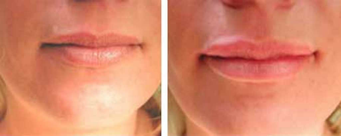 Photo of Lip Injections NYC in New York City, New York, United States - 10 Picture of Point of interest, Establishment, Health, Doctor