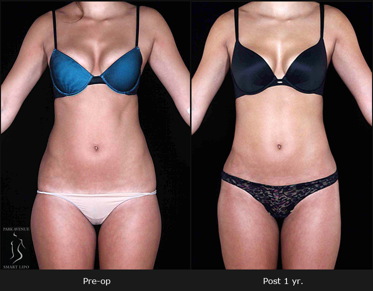 Photo of Park Avenue Smart Lipo in New York City, New York, United States - 6 Picture of Point of interest, Establishment, Health, Doctor