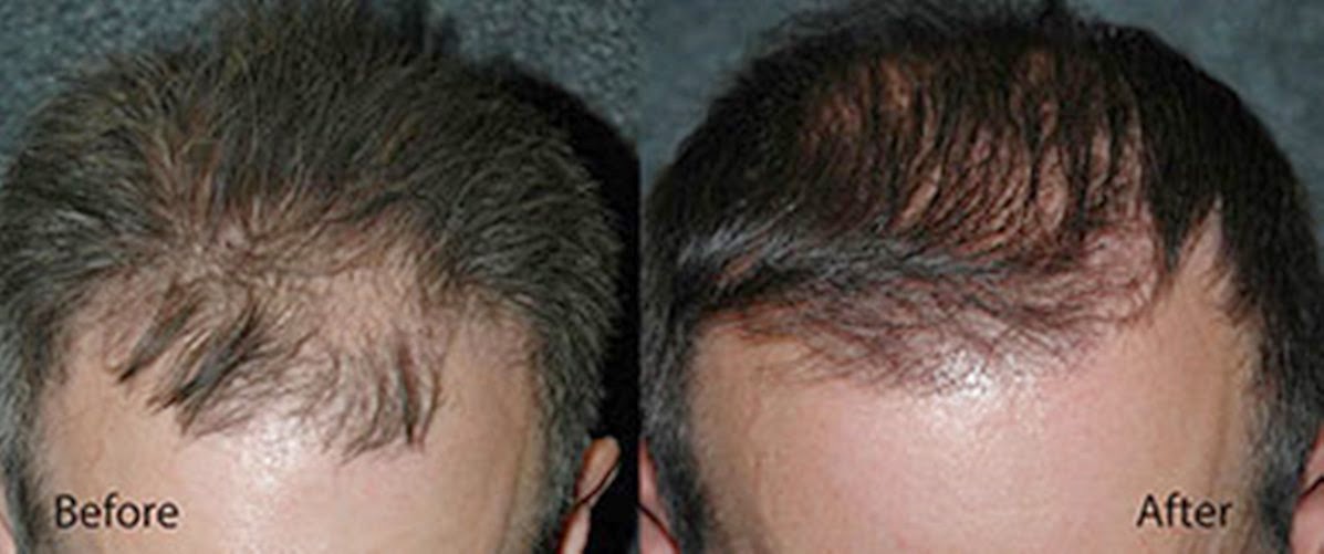 Photo of New York Hair Transplantation in Great Neck City, New York, United States - 9 Picture of Point of interest, Establishment, Health, Hospital, Doctor, Hair care