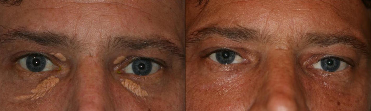 Photo of Xanthelasma NYC in New York City, New York, United States - 2 Picture of Point of interest, Establishment, Health, Doctor