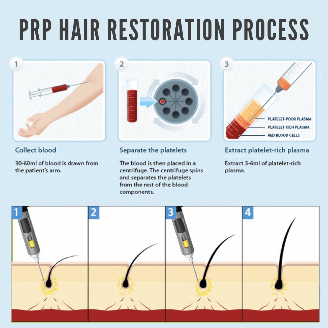 Photo of PRP Hair MD New Jersey in Englewood Cliffs City, New Jersey, United States - 3 Picture of Point of interest, Establishment, Health, Hair care