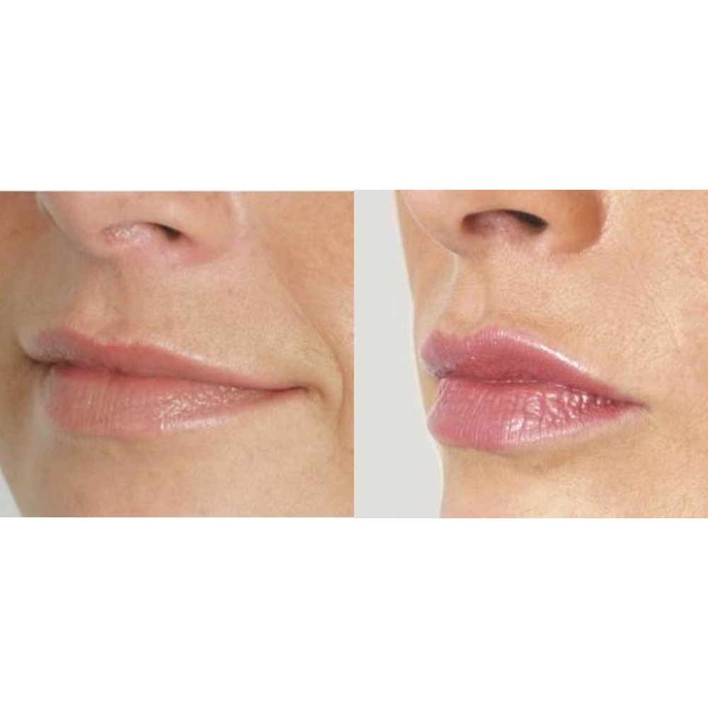 Photo of Lip Injections NYC in New York City, New York, United States - 9 Picture of Point of interest, Establishment, Health, Doctor