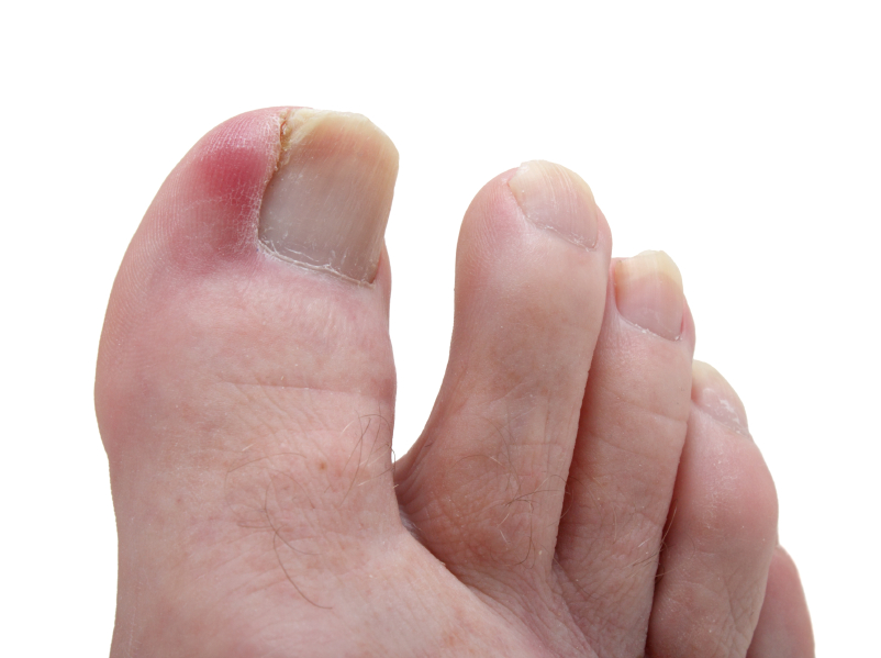 Photo of Ingrown Toenail Therapy in Bronx City, New York, United States - 5 Picture of Point of interest, Establishment, Health, Doctor