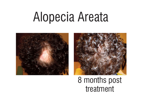 Photo of Hair Restoration of America-A Division of Laser Plus Spa in Bellmore City, New York, United States - 7 Picture of Point of interest, Establishment, Health, Hair care