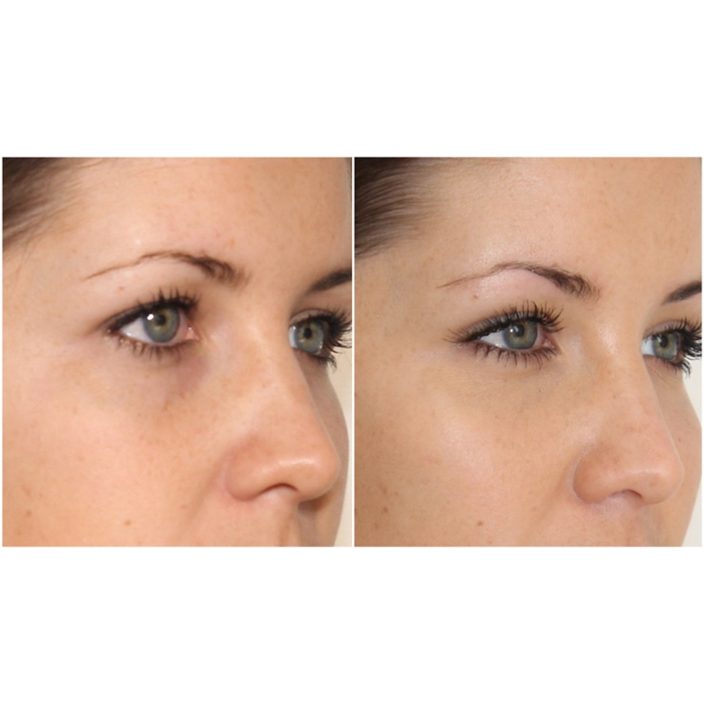 Photo of Eye Fillers NYC in New York City, New York, United States - 5 Picture of Point of interest, Establishment, Health, Doctor