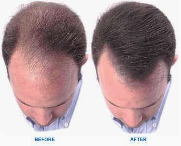 Photo of Institute for Hair Restoration in New York City, New York, United States - 3 Picture of Point of interest, Establishment, Health, Doctor, Hair care