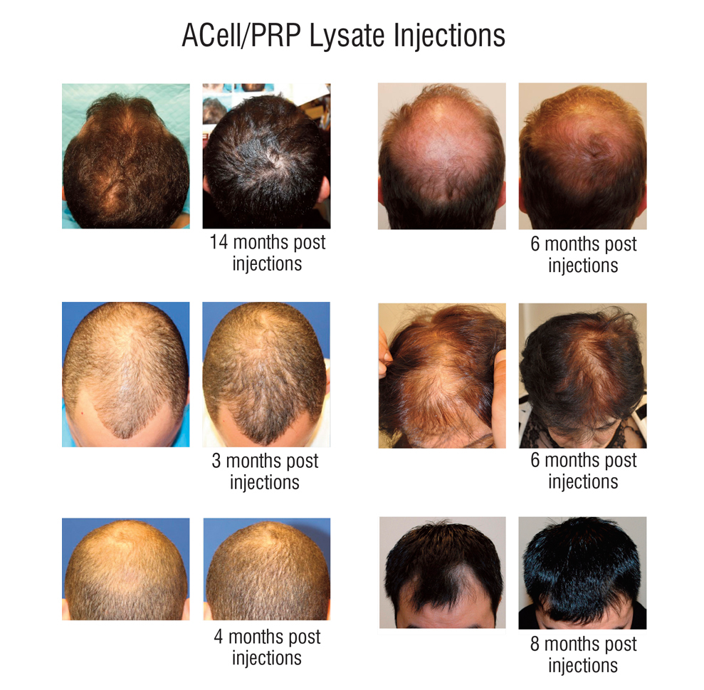 Photo of Hair Restoration of America-A Division of Laser Plus Spa in Bellmore City, New York, United States - 1 Picture of Point of interest, Establishment, Health, Hair care