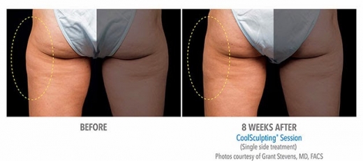 Photo by <br />
<b>Notice</b>:  Undefined index: user in <b>/home/www/activeuser/data/www/vaplace.com/core/views/default/photos.php</b> on line <b>128</b><br />
. Picture for CoolSculpting Spa of Long Island in Great Neck City, New York, United States - Point of interest, Establishment, Health, Hospital, Doctor