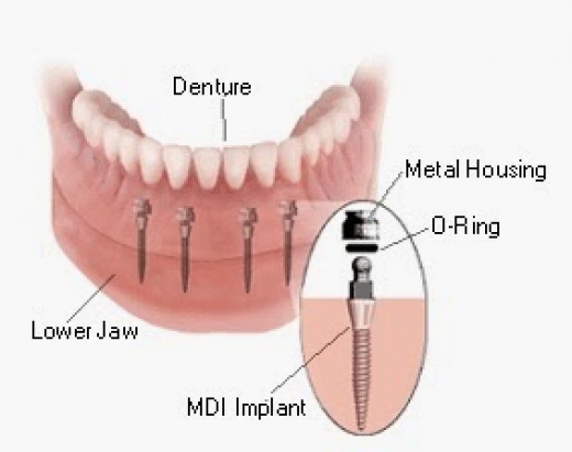 Sanford N. Gerber, DDS Mini Dental Implants in Elmont City, New York, United States - #4 Photo of Point of interest, Establishment, Health, Dentist