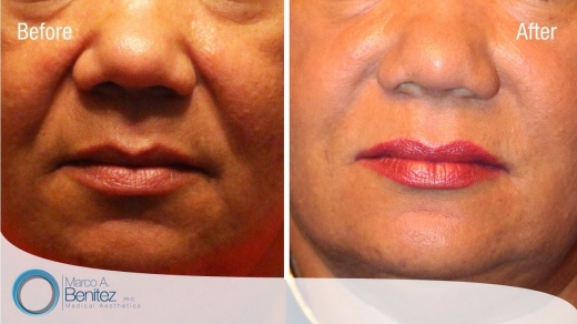 Photo by <br />
<b>Notice</b>:  Undefined index: user in <b>/home/www/activeuser/data/www/vaplace.com/core/views/default/photos.php</b> on line <b>128</b><br />
. Picture for Premier Aesthetics- Astoria Botox Dermal Filler Plasma PRP in Queens City, New York, United States - Point of interest, Establishment, Health, Spa